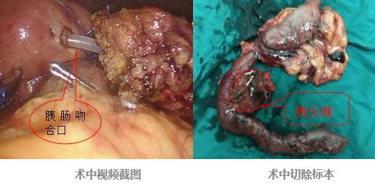  黄蜂三球接受左腕手术根治  